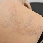 Does Laser Tattoo Removal Leave A Scar