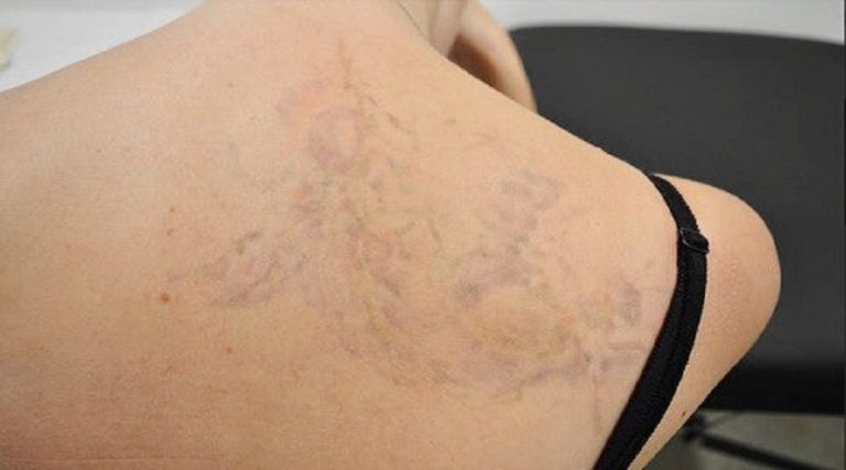 Does Laser Tattoo Removal Leave A Scar