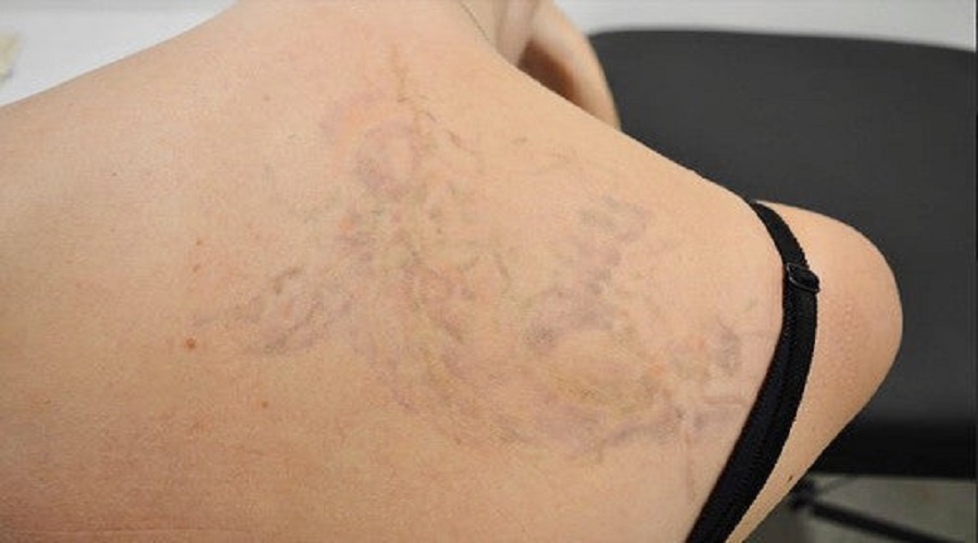 Does Laser Tattoo Removal Leave A Scar?