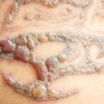 Does Tattoo Removal Leave Scars