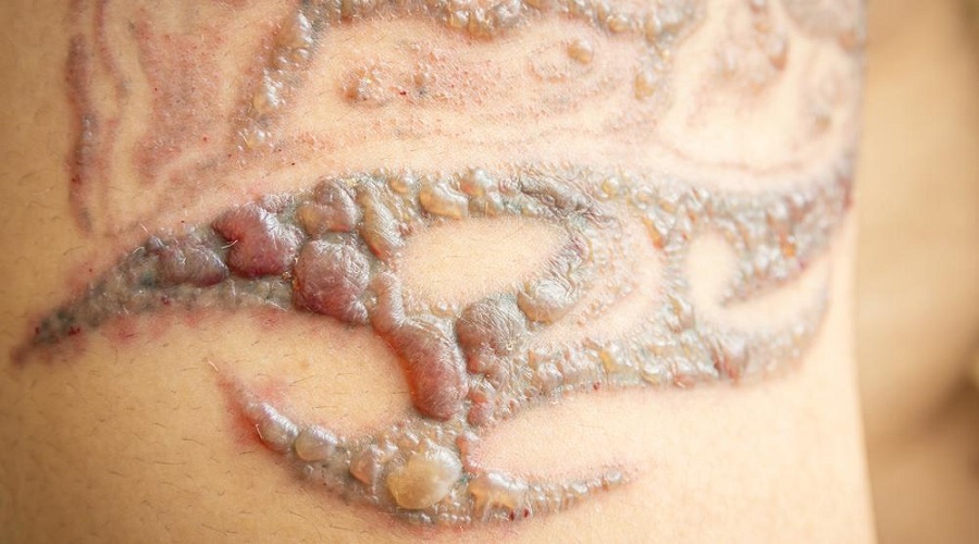 Does Tattoo Removal Leave Scars