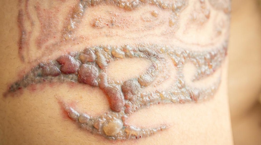Does Tattoo Removal Leave Scars?