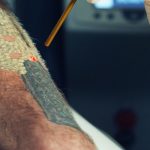 How Bad Does Tattoo Removal Hurt