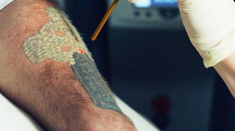 How Bad Does Tattoo Removal Hurt