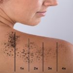 How Many Treatments To Remove Tattoo