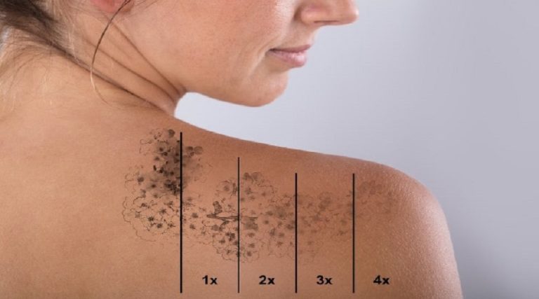 How Many Treatments To Remove Tattoo