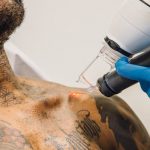 How Much Does Tattoo Removal Hurt