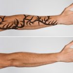 What Does Tattoo Removal Feel Like