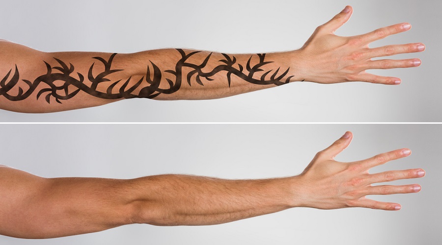 What Does Tattoo Removal Feel Like?