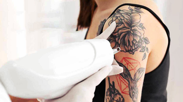 Can You Get Laser Hair Removal Over A Tattoo?