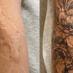 Can A Scar Be Tattooed Over