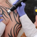 Does Insurance Cover Tattoo Removal