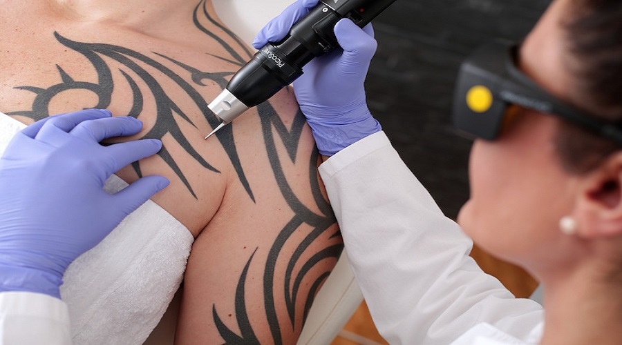 Does Insurance Cover Tattoo Removal