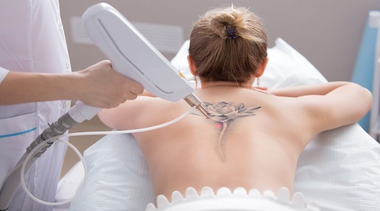 Does Laser Tattoo Removal Cause Cancer