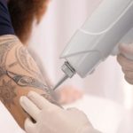 How To Become A Tattoo Removalist