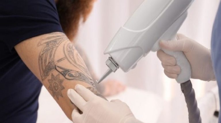How To Become A Tattoo Removalist