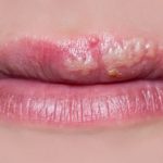 How To Treat Cold Sore After Lip Tattoo