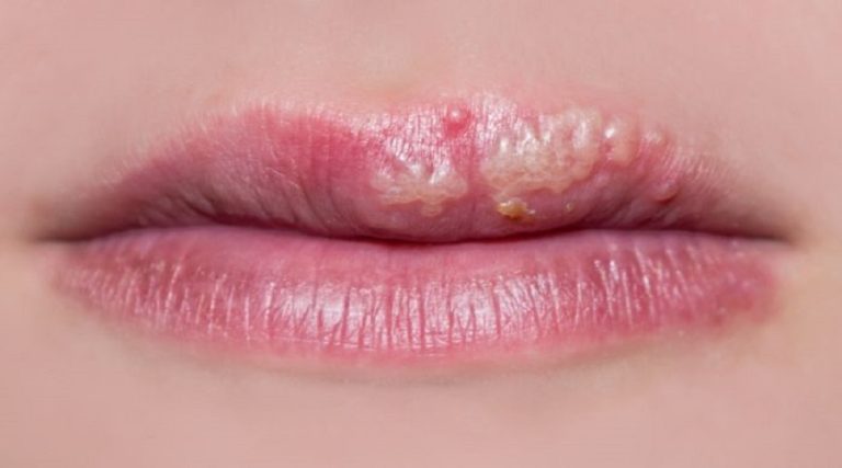 How To Treat Cold Sore After Lip Tattoo