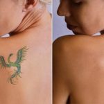 What Does Skin Look Like After Tattoo Removal