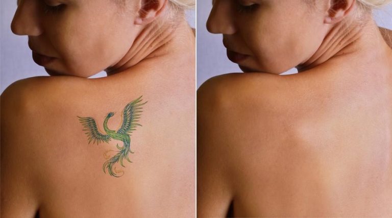 What Does Skin Look Like After Tattoo Removal