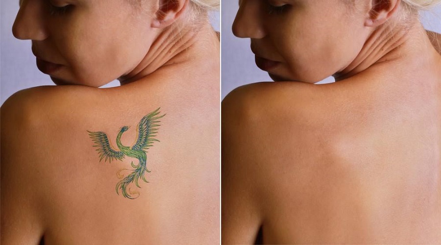 What Does Skin Look Like After Tattoo Removal?